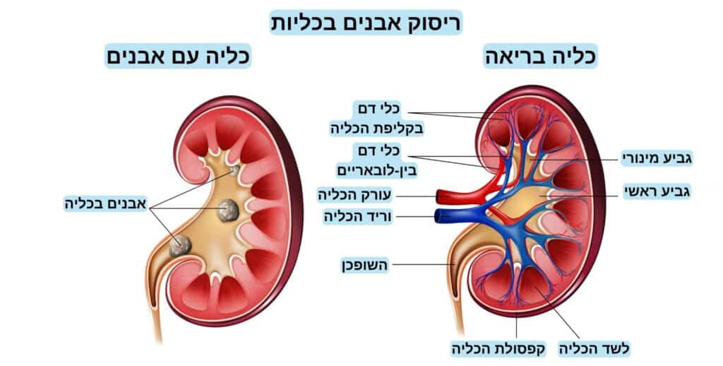 ריסוק אבנים בכליות -דוקטור אסף בר אל